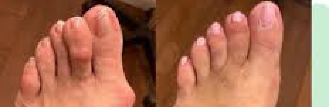 Flat Foot Therapy Perth Amboy, NJ