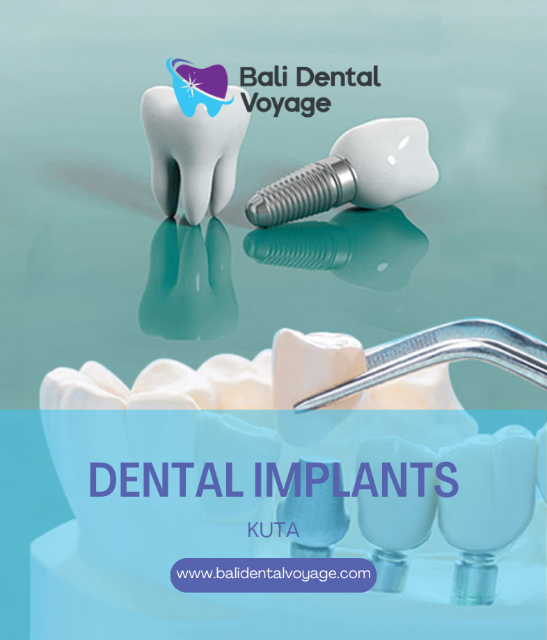 Dental Implants Kuta Bali | Bali Dental Voyage