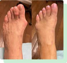 Flat Foot Therapy Perth Amboy, NJ