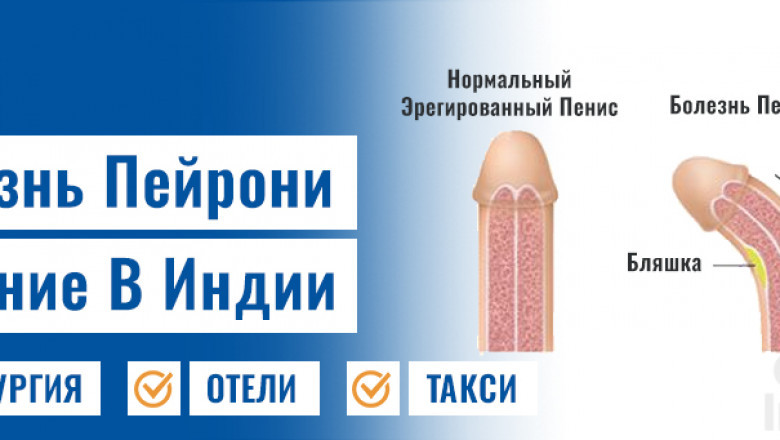 Как лечить болезнь Пейрони и предстательная железа гиперплазия : пошаговое руководство | Times Square Reporter