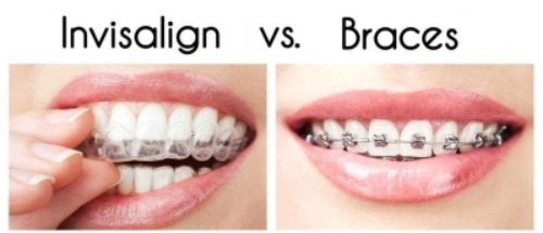 Invisalign Boston: The Clear Way To A Better Smile: quincyortho — LiveJournal