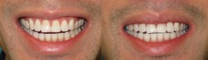 Teeth Whitening Markham | Avatar Dental