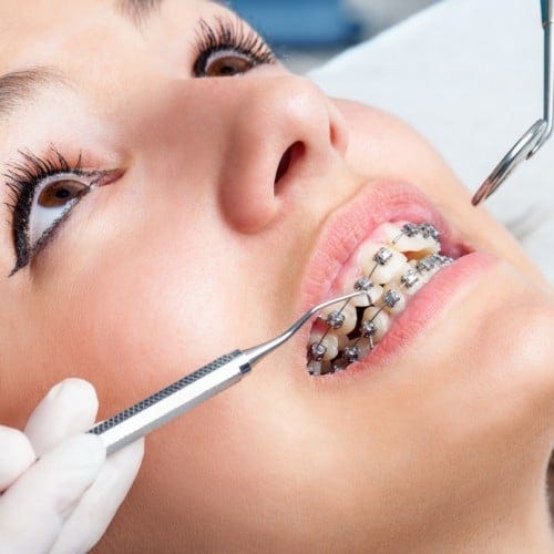 Braces Boston: Smiles For Every Occasion, Brought To You by Quincy Orthodontics | by Align Orthodontics | May, 2025 | Medium