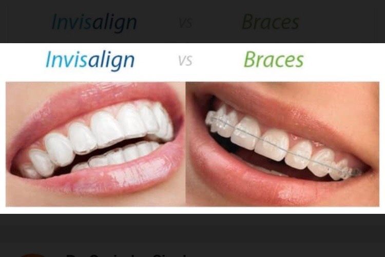 Invisible Aligners Noida Sector 12