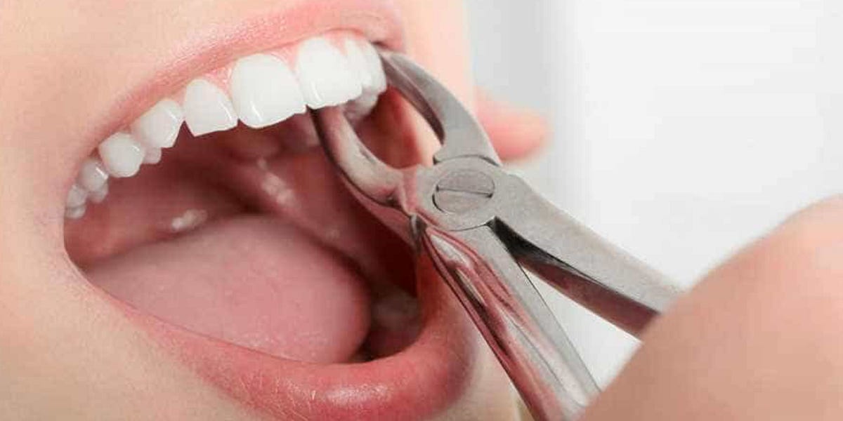 Surgical Extraction Dentist Noida Sector 12